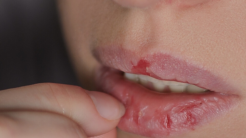 Có nên bóc vảy môi khi môi khô nứt nẻ không? 1