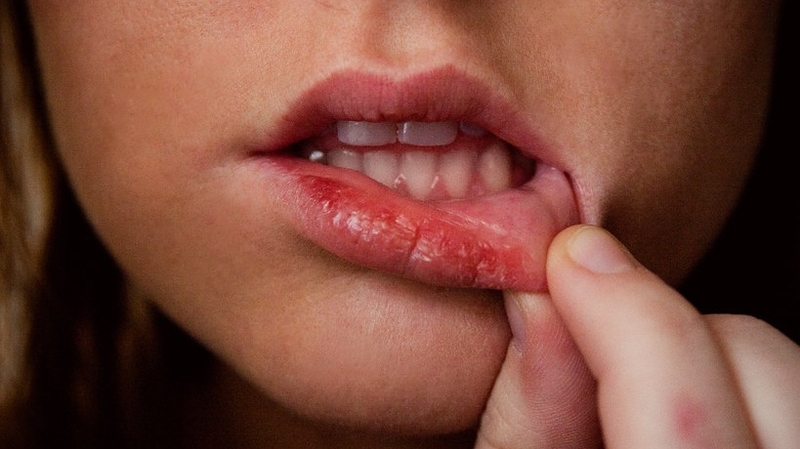 Có nên bóc vảy môi phun không? 3