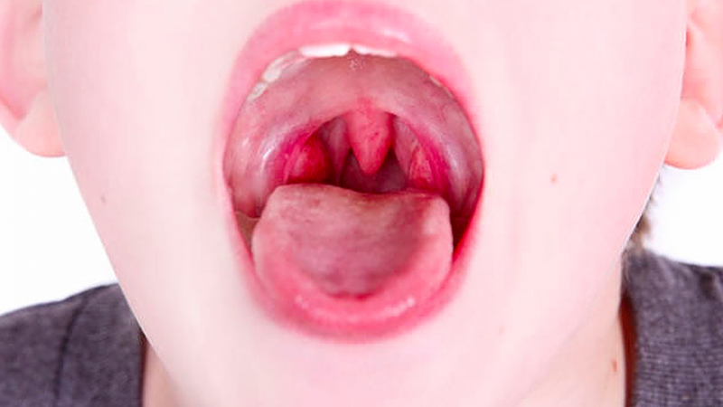 Có nên cắt amidan không? Khi nào và có đau không? 4