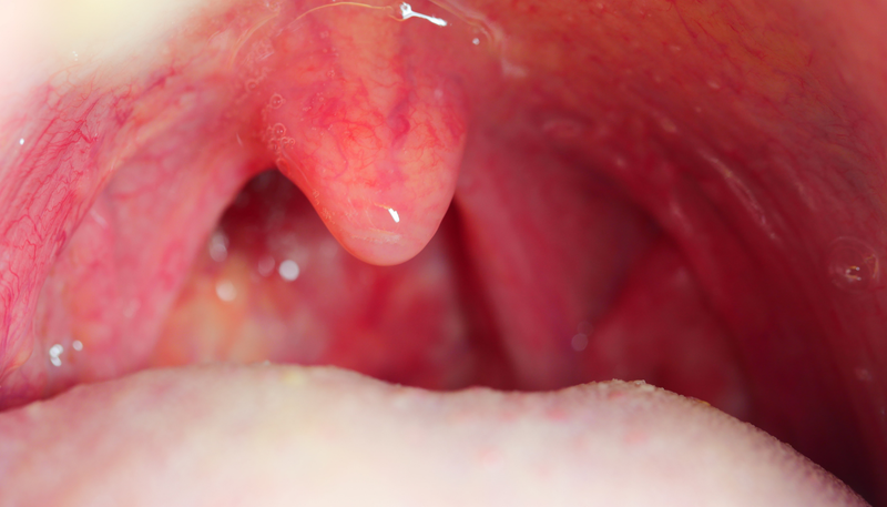 Có nên cắt amidan không? Khi nào và có đau không? 1