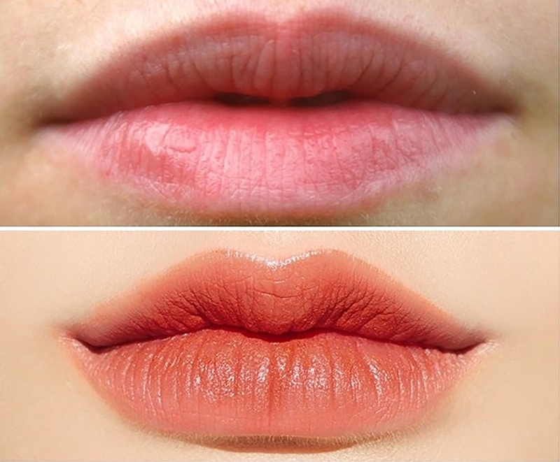 Có nên cắt môi trái tim không? Thẩm mỹ môi trái tim có để lại sẹo? 2