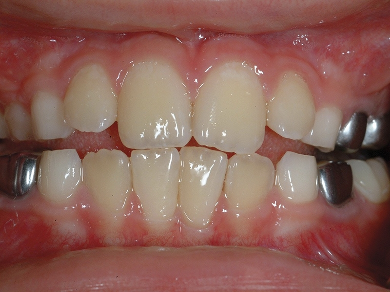 Có nên chụp thép răng sữa cho trẻ hay không? 1