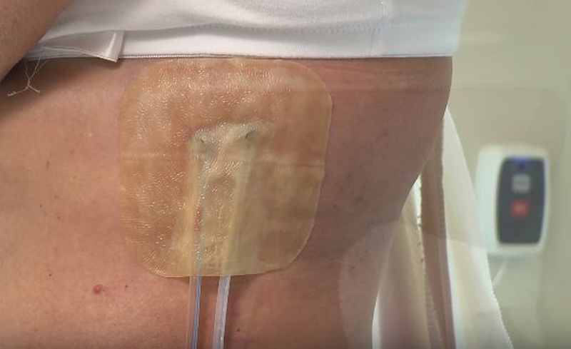 Dán cao hút mủ cần vệ sinh cẩn thận