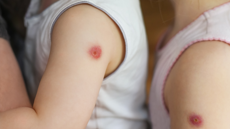 Có nên dán miếng hạ sốt vào chỗ tiêm? Cách chăm sóc trẻ sau khi tiêm vắc xin 3