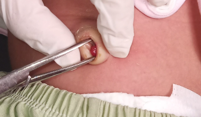 Có nên đeo băng rốn cho trẻ sơ sinh? Những lưu ý khi chăm sóc rốn cho trẻ sơ sinh 4