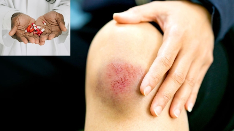 Có nên dùng thuốc tan máu bầm do chấn thương không là băn khoăn của nhiều độc giả
