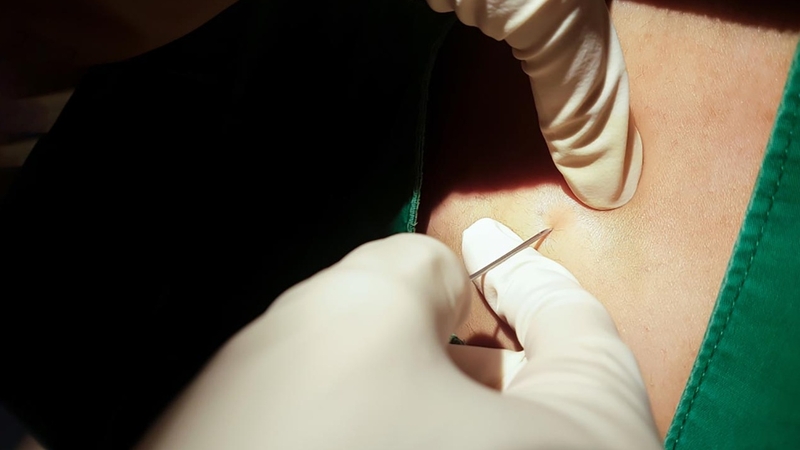 Có nên gây tê ngoài màng cứng khi sinh thường và những biến chứng? 1