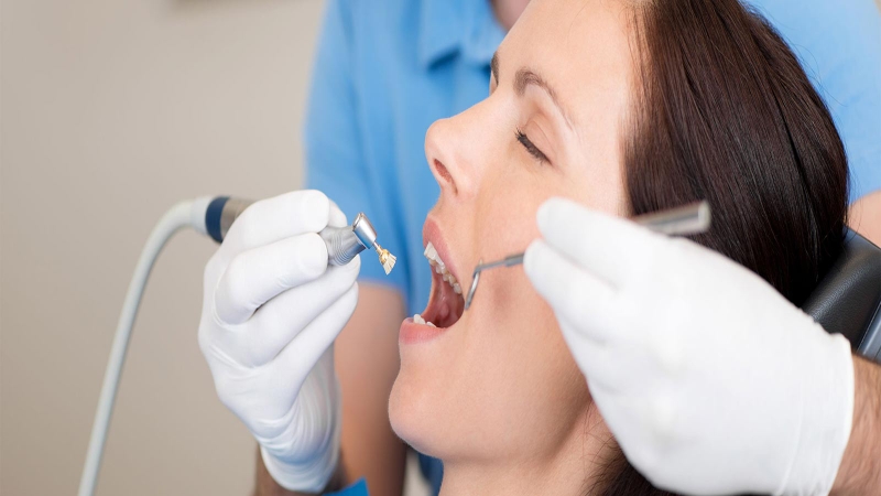 Có nên lấy cao răng không? Một số lợi ích khi lấy cao răng 2