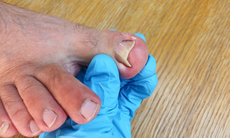 Có nên lấy khoé móng chân không? Cách để lấy khóe móng chân an toàn1