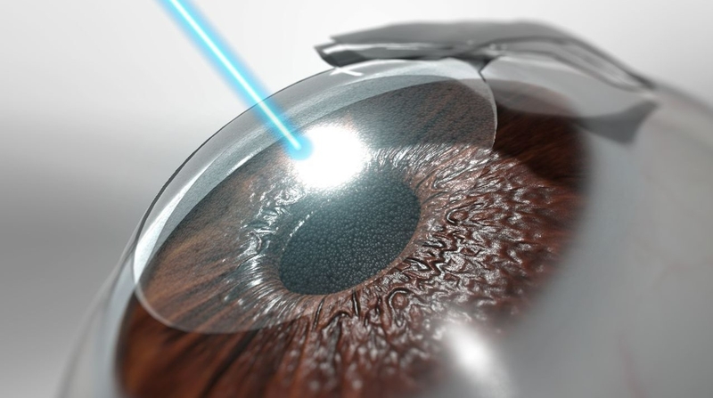 Có nên mổ mắt cận không? Tìm hiểu các phương pháp mổ cận 3