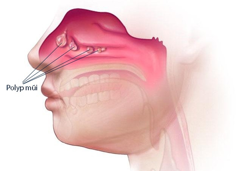Mổ polyp mũi hết bao nhiêu tiền phụ thuộc vào tình trạng bệnh của bệnh nhân