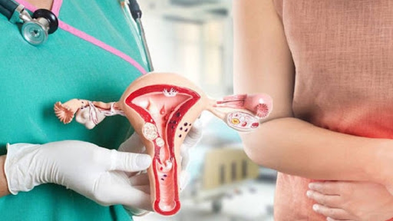 Những chia sẻ về vấn đề có nên mổ u lạc nội mạc tử cung hay không?