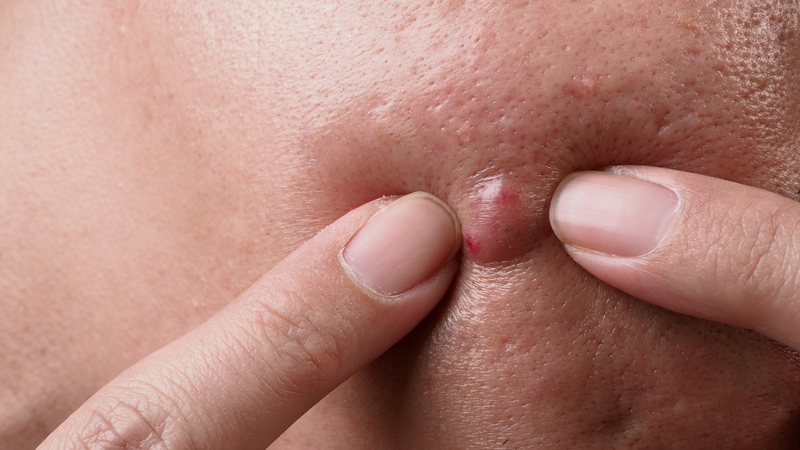 Tự ý nặn mụn u bã đậu có thể để lại sẹo xấu trên da