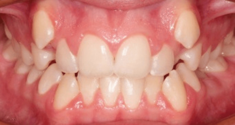 Có nên nhổ răng khểnh không? Nhổ răng khểnh có sao không? 1