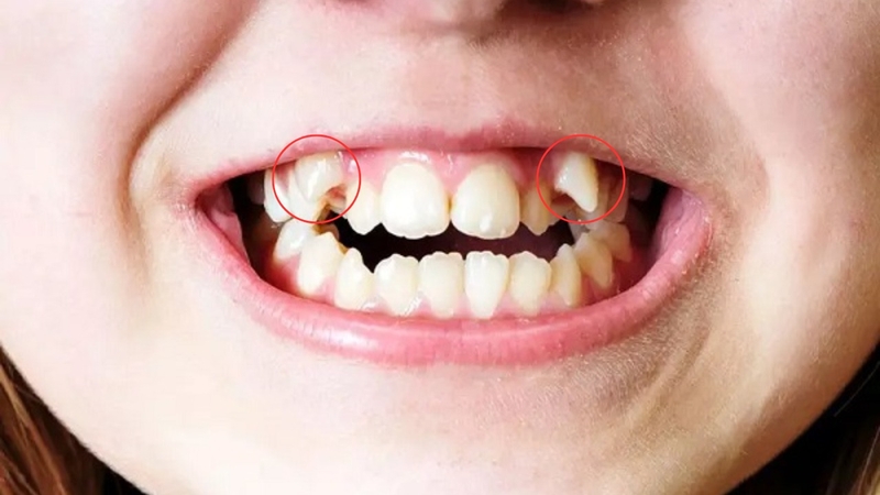 Có nên nhổ răng khểnh không? Nhổ răng khểnh có sao không? 3