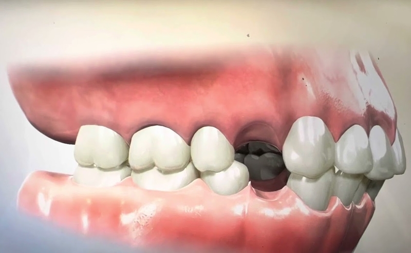 Giải đáp thắc mắc: Có nên nhổ răng số 4 để niềng không 2