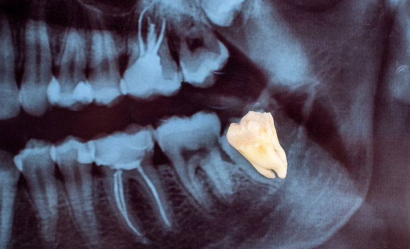 Có nên nhổ răng số 8 hàm dưới không 1