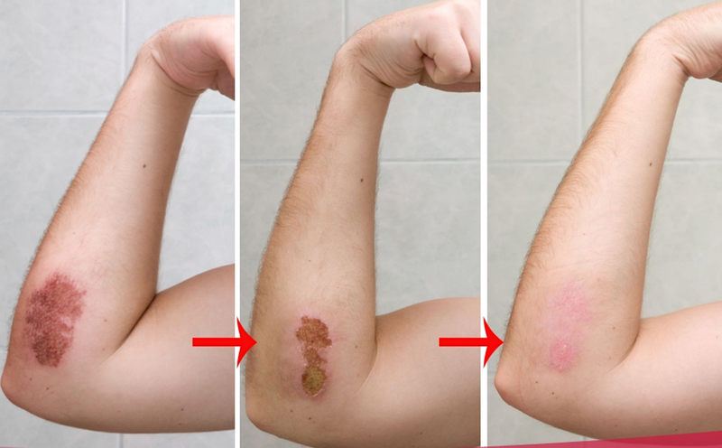 Dùng nước muối rửa giúp vết thương nhanh lành hơn