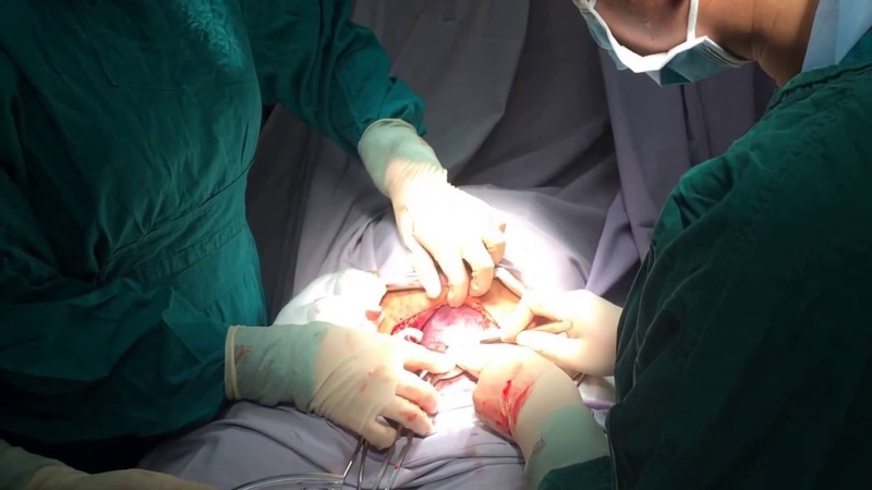 Có nên sinh mổ lần 3 hay không 1