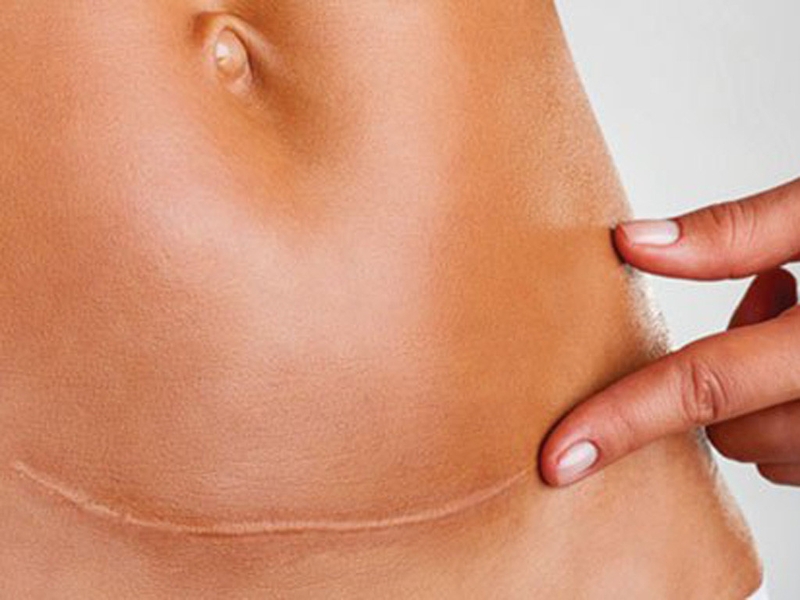 Có nên sinh mổ lần 3 hay không 3