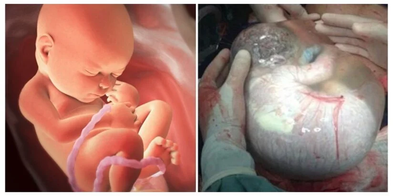 Có nên sinh mổ ở tuần 37 không?