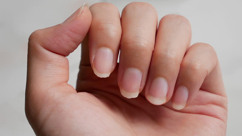 Móng yếu dễ gãy có thể liên quan đến tình trạng thiếu hụt biotin