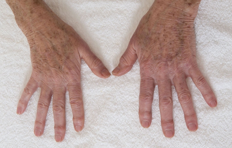 Có nên sử dụng kem trị đồi mồi ở tay Kpem? 1