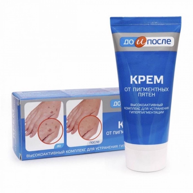 Có nên sử dụng kem trị đồi mồi ở tay Kpem? 4