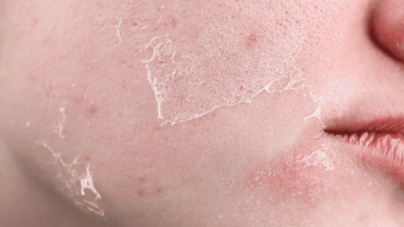 Da khô nên tẩy tế bào chết 1-2 lần/tuần kết hợp dưỡng ẩm đầy đủ và tránh scrub hạt thô để hạn chế khô ráp, kích ứng