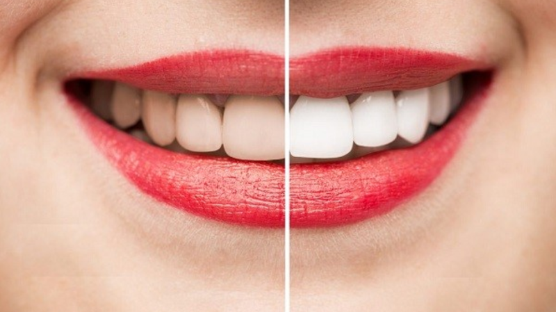 Có nên tẩy trắng răng không? Chi phí bao nhiêu? 1