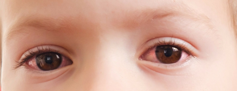 Có nên thông tuyến lệ cho trẻ sơ sinh hay không? 1