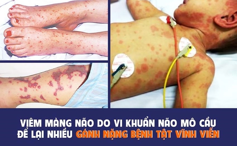 có nên tiêm viêm màng não mô cầu bc không 2