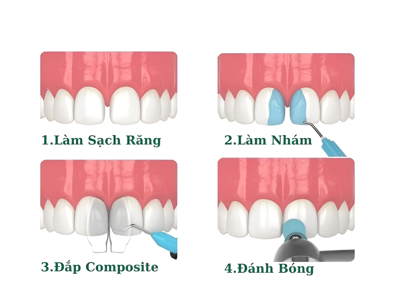 Có nên trám răng thưa không? Quy trình trám răng thưa diễn ra như thế nào? 3