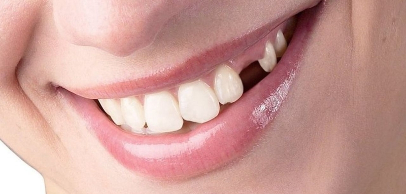 Có nên trồng răng giả không? Nhổ răng bao lâu thì trồng lại được? 2