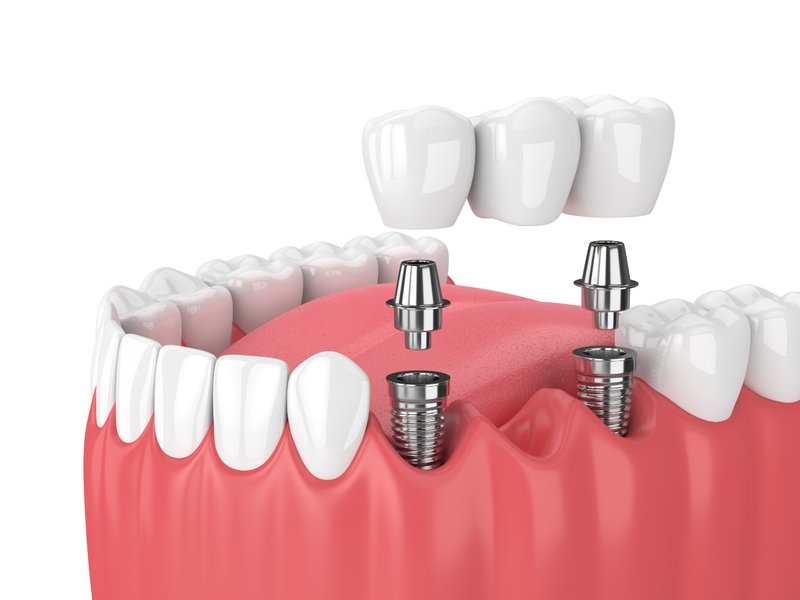 Có nên trồng răng implant không? Ưu điểm của trồng răng implant 3