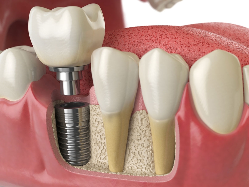 Có nên trồng răng implant không? Ưu điểm của trồng răng implant 4