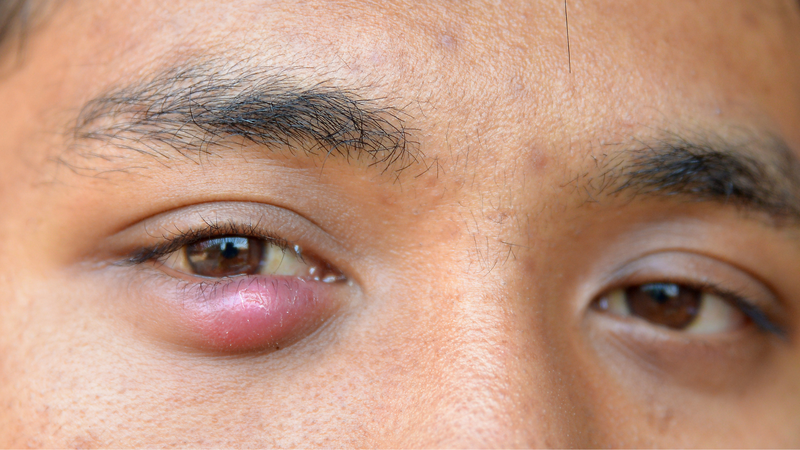 Không nên tự chích lẹo mắt tại nhà