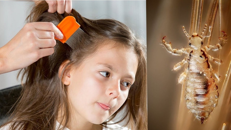 Có những cách trị chấy bằng muối nào hiệu quả 1