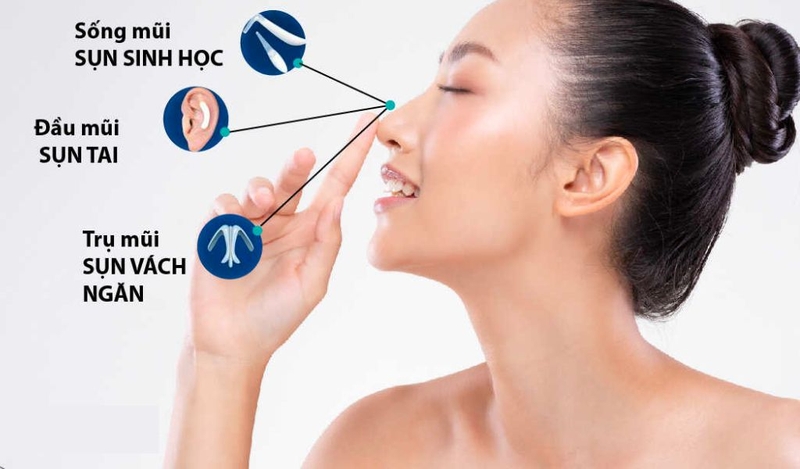 Có những loại sụn nâng mũi nào? Nên lựa chọn loại sụn nâng mũi nào? 1