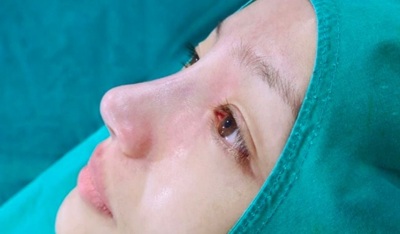 Có những loại sụn nâng mũi nào? Nên lựa chọn loại sụn nâng mũi nào? 3