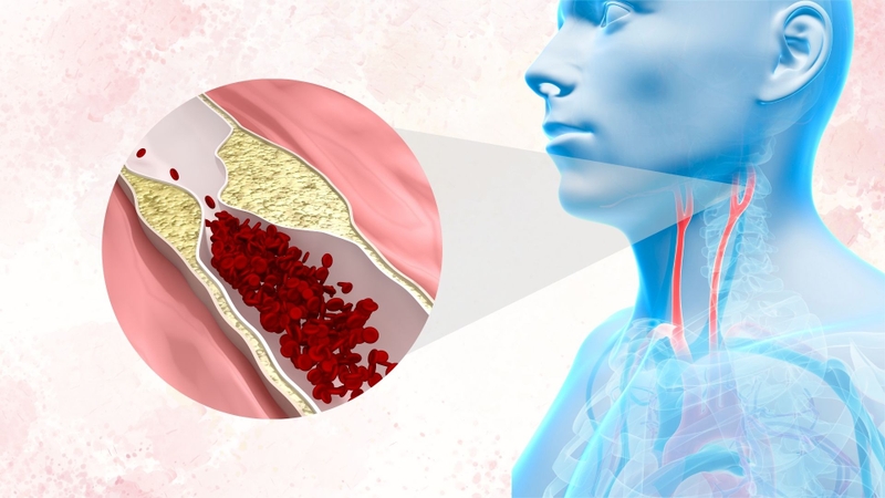 Có những phương pháp điều trị hẹp động mạch cảnh nào? Vì sao cần can thiệp sớm? 1