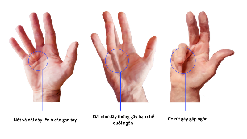 Co rút Dupuytren: Nguyên nhân, triệu chứng và điều trị 5