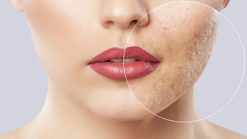 Có thật là Vitamin C có thể giúp trị sẹo lõm? 1