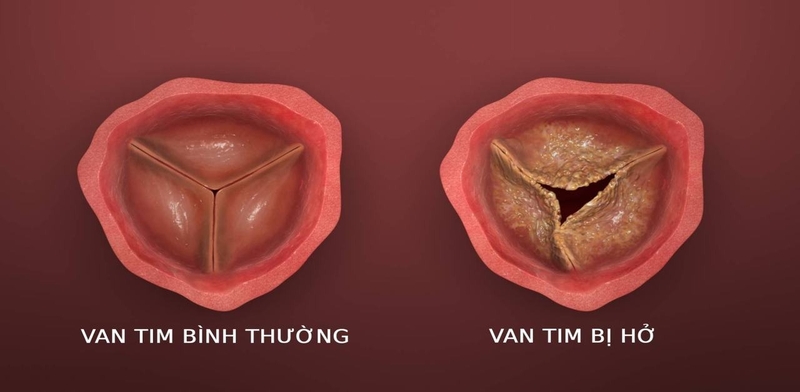 Có thật sự cây sài đất chữa hở van tim được không? -3