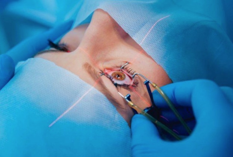 Có thể mổ mắt cận được mấy lần? 1