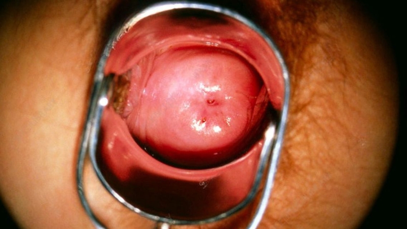 Nhiều phụ nữ chưa hiểu rõ&nbsp;cổ tử cung láng là gì