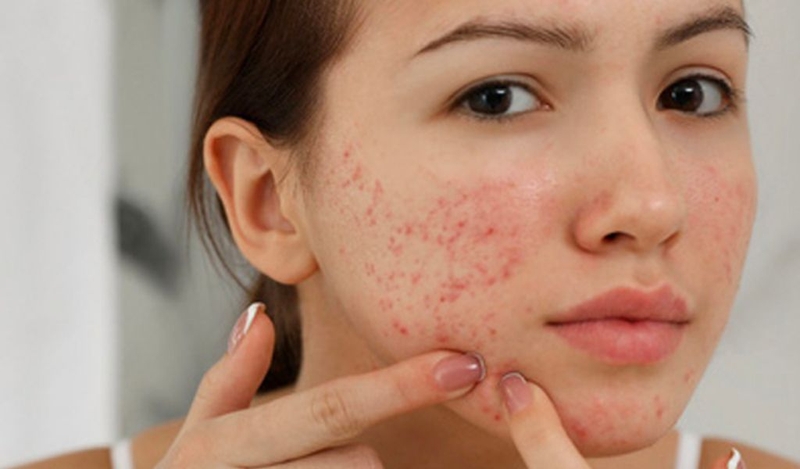 Cồi mụn là gì? Cách gom cồi mụn nhanh chóng tại nhà 3