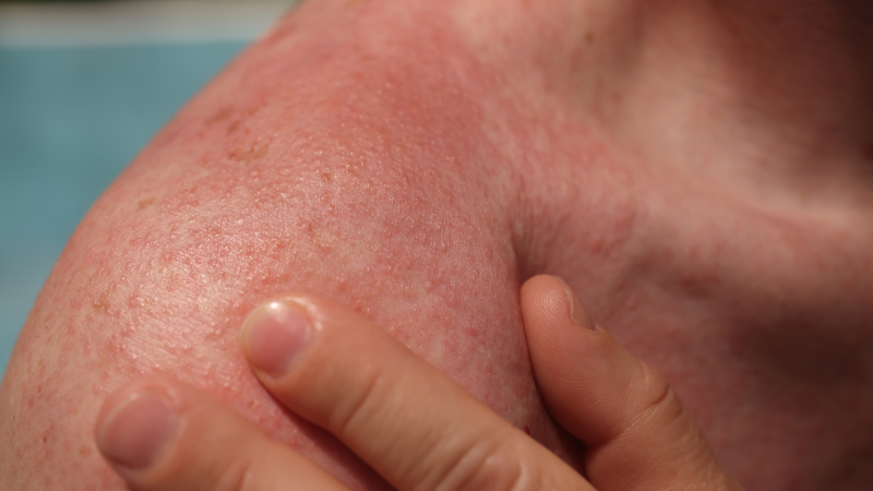 Việc để da tiếp xúc trực tiếp với nắng có thể gây cháy nắng