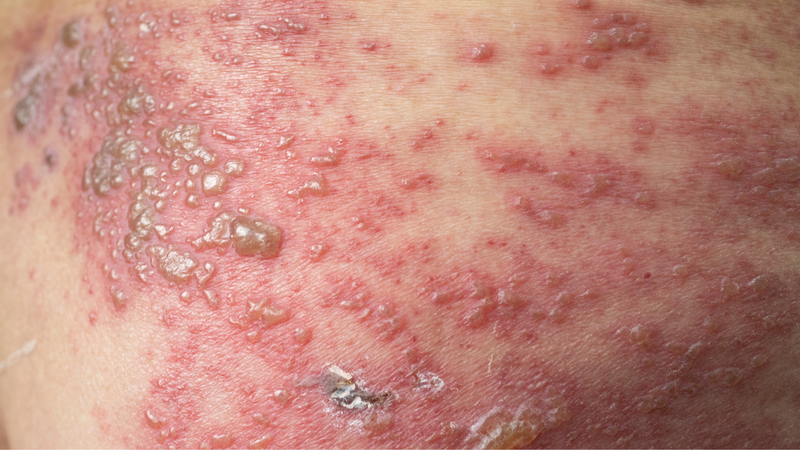 Hình ảnh con giời leo và một số thể bệnh giời leo phổ biến 2