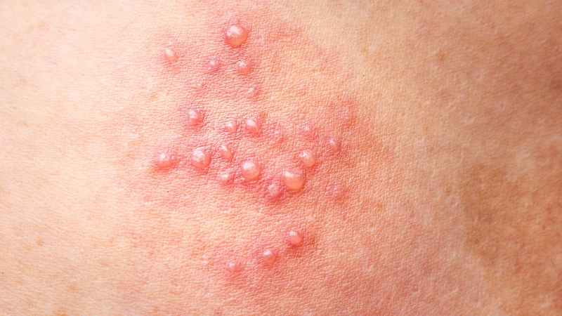 Con giời leo là gì? Một số thể bệnh giời leo phổ biến 3